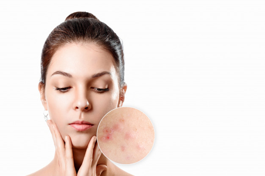 Acne Problem