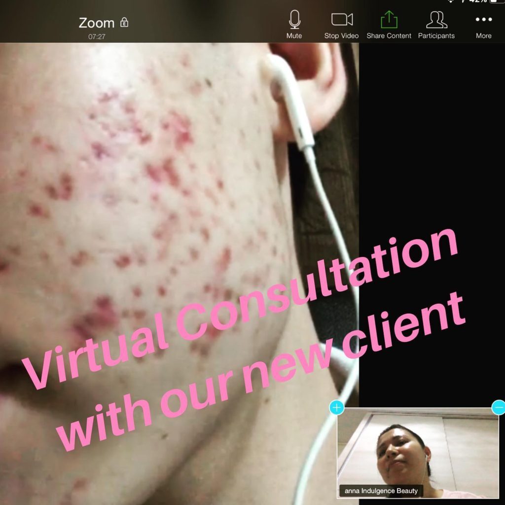 Acne Prone Skin Virtual Consultation