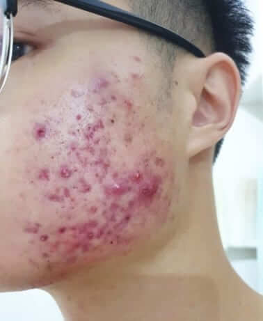 Face With Severe Pimple