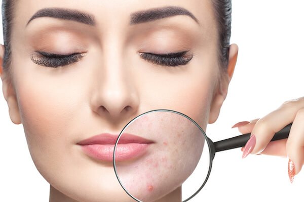 Guidelines to Manage Acne Vulgaris for Cclearer Skin