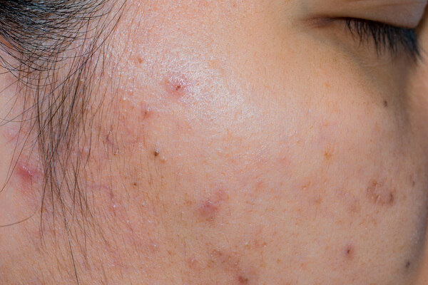 How Can Get Rid Of Acne Scars on Face