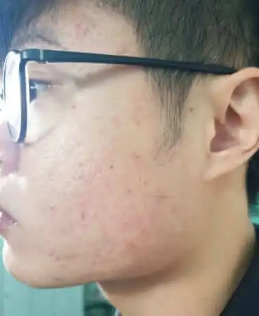 face-with-pimples
