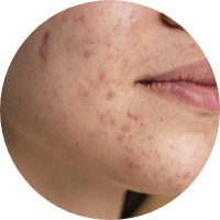 Acne Skin