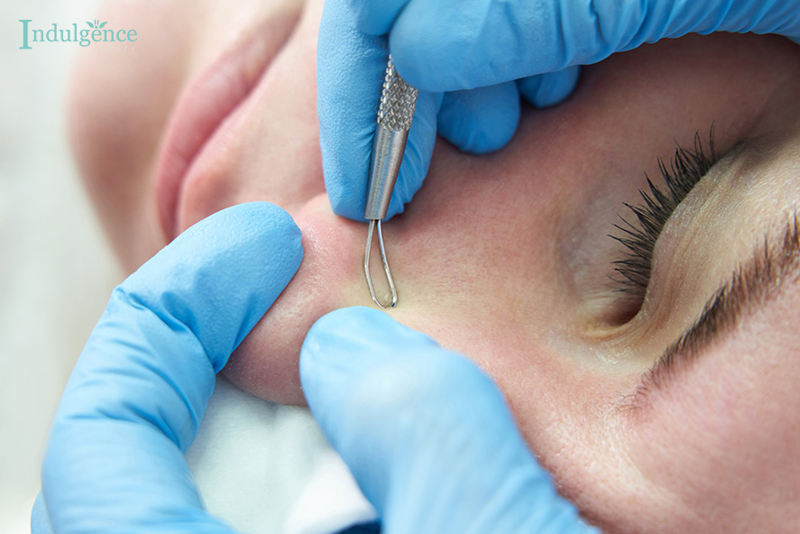 Clearing the Cloud: Understanding and Preventing Whiteheads